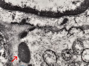 brain vessel - CADASIL - arrow:granular osmiophilic material (GOM)in basement membrane